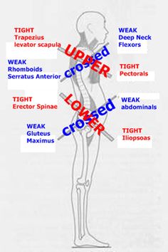 upper cross syndrome