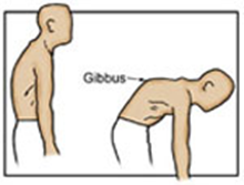 scheuermann's kyphosis.  A type of kyphotic posture.