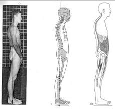 three sway back posture images, side by side.