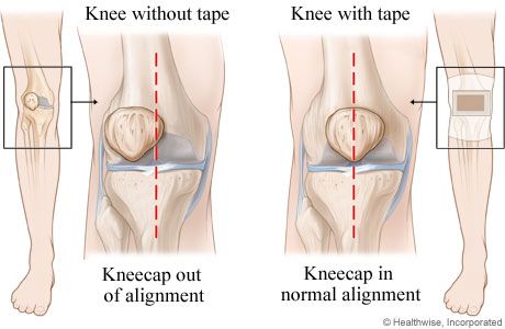 Two knee images, normal knee on the right and knee with patellar tracking order on the left.