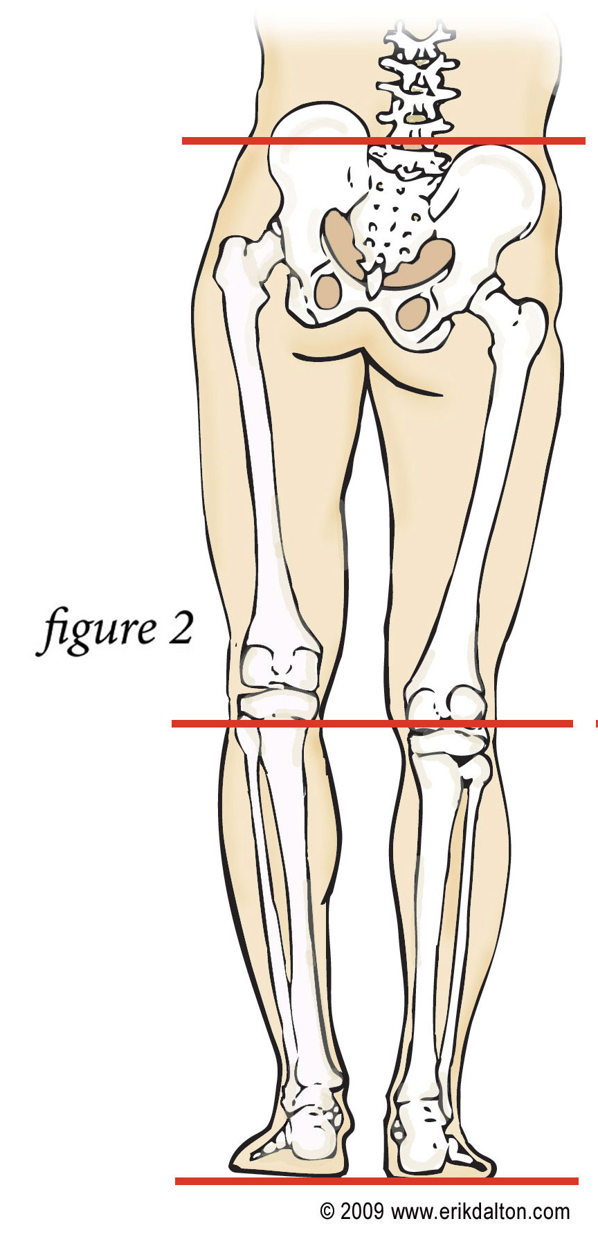 skeleton of a person with one leg longer than the other
